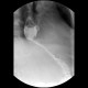 Carcinoma of esophagus, distal esophagus, placement of stent, liver metastasis: RF - Fluoroscopy